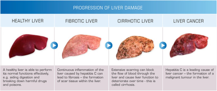 1 Progression Of Liver Damage