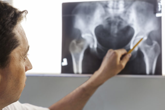 Doctor pointing at x-ray of a pelvis